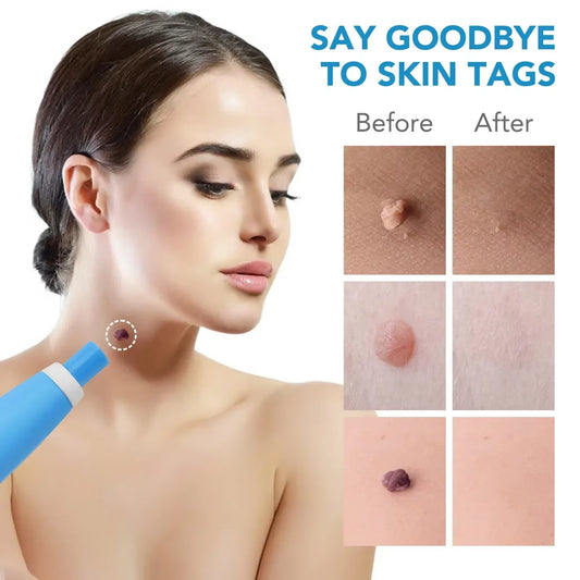 Dual Head Wart Removal Kit Flat Plantar Wart Remover Liquid Pen Flesh Mole Remover Chicken Eye Wart Remover