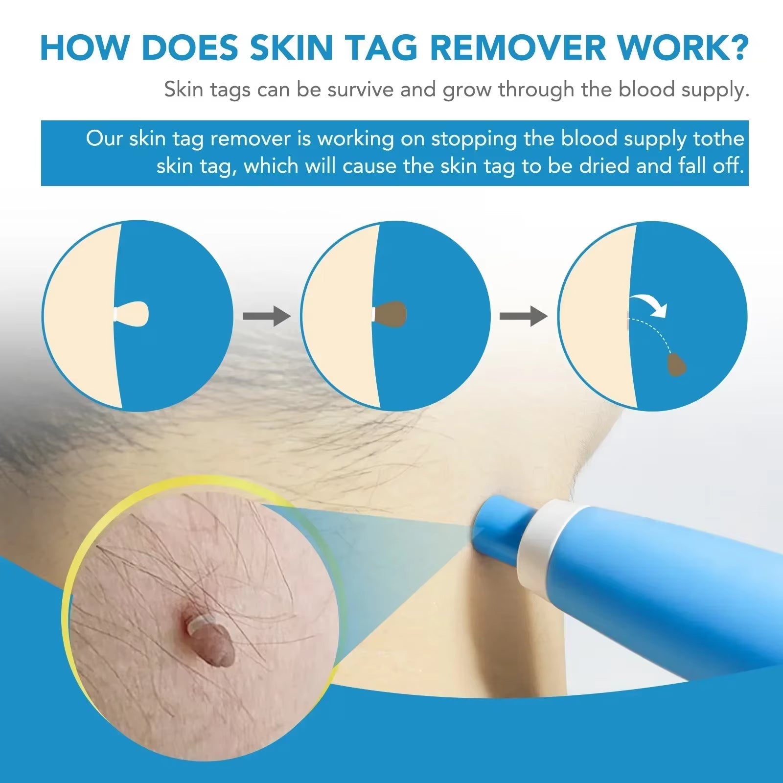 Dual Head Wart Removal Kit Flat Plantar Wart Remover Liquid Pen Flesh Mole Remover Chicken Eye Wart Remover